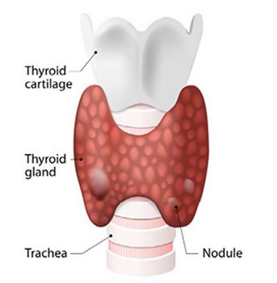 วิธีการเลือกการรักษาต่อมไทรอยด์แบบธรรมชาติ Thyroid Stimulating Hormone